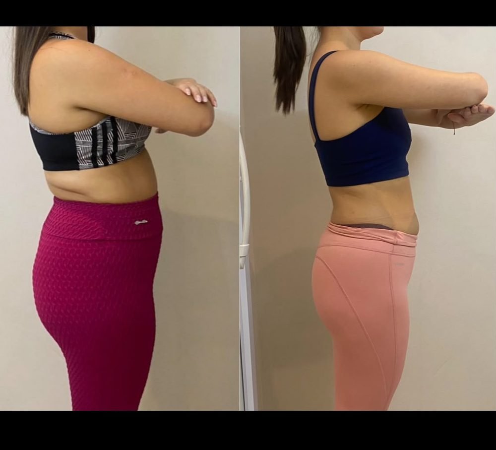 Resultado de acompanhamento — antes e depois